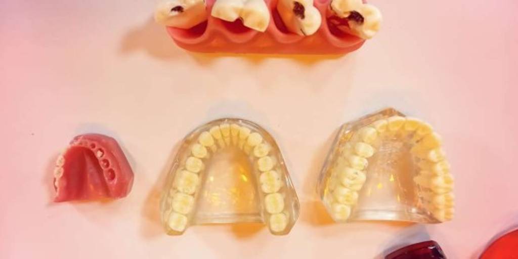 Qué es un sellante dental y qué beneficios tiene