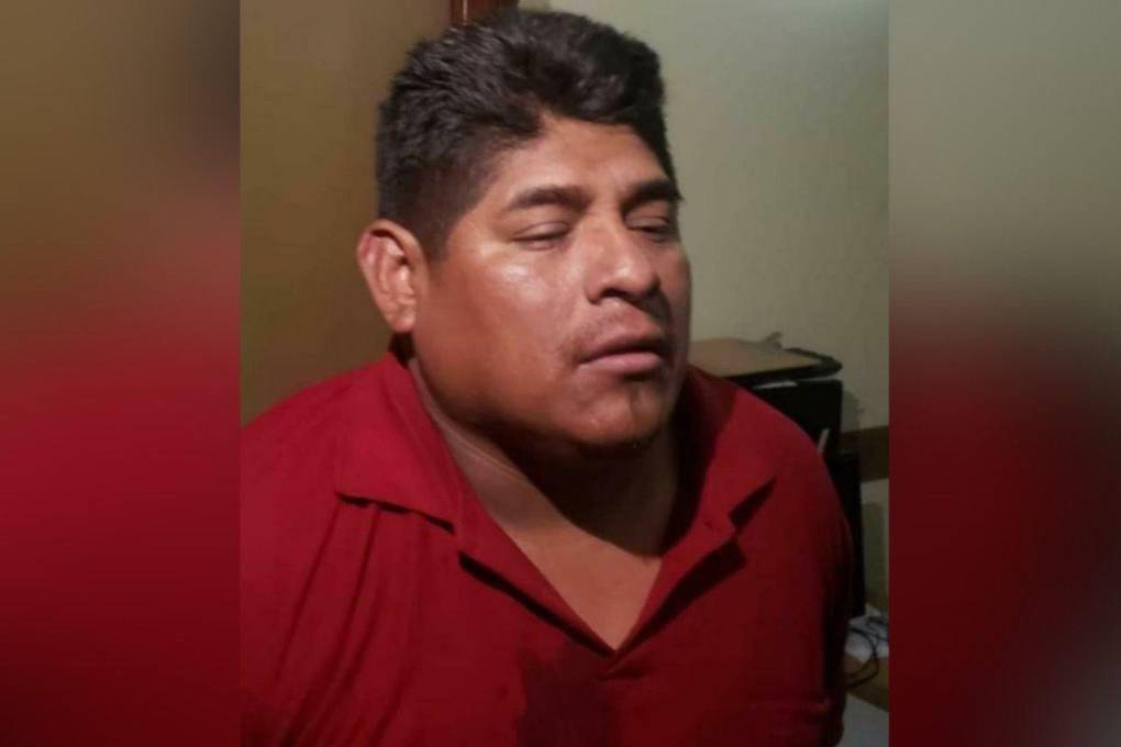 Informe forense señala que cocalero Apaza tiene contusiones y otorga cuatro días de impedimento