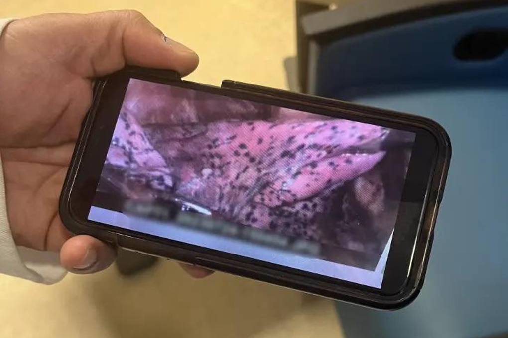 Así quedó su pulmón 