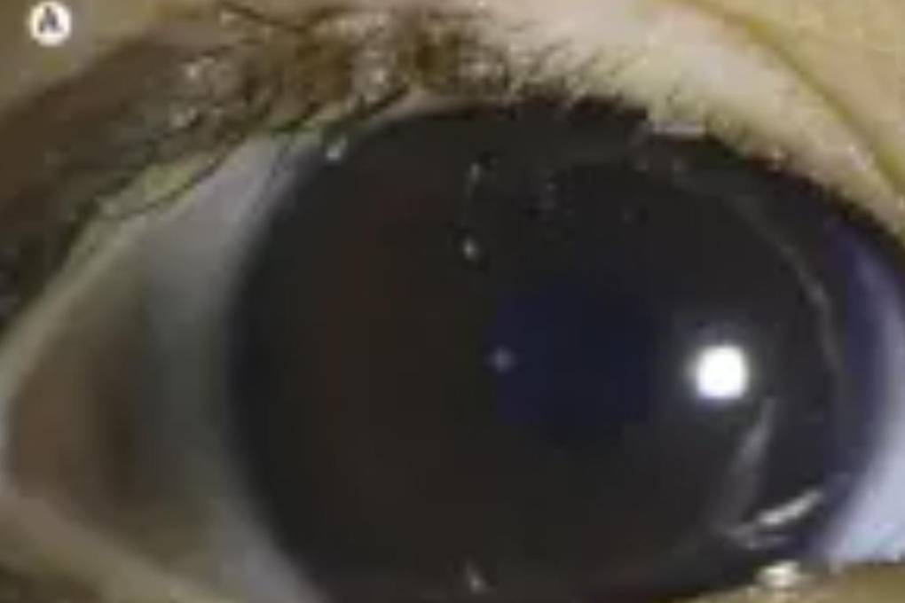 Así se veía el ojo del paciente de tres años con liendres en sus pestañas