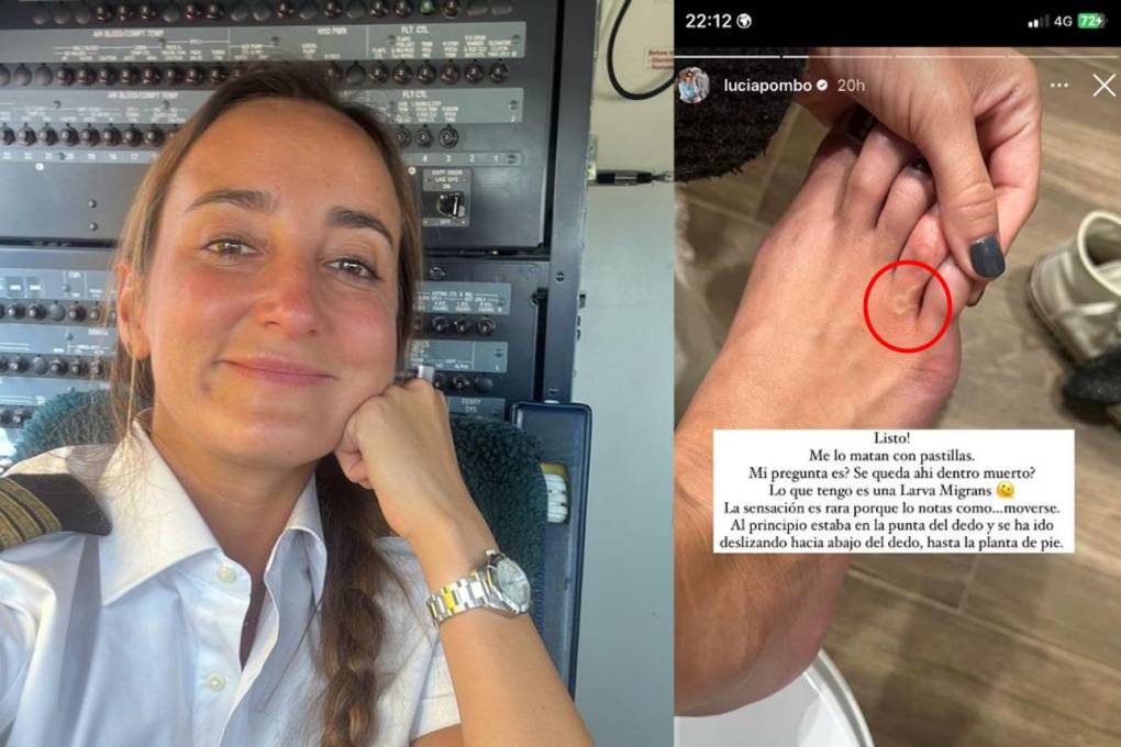 La influencer Lucía Pombo mostró el gusano que tiene en su pie 