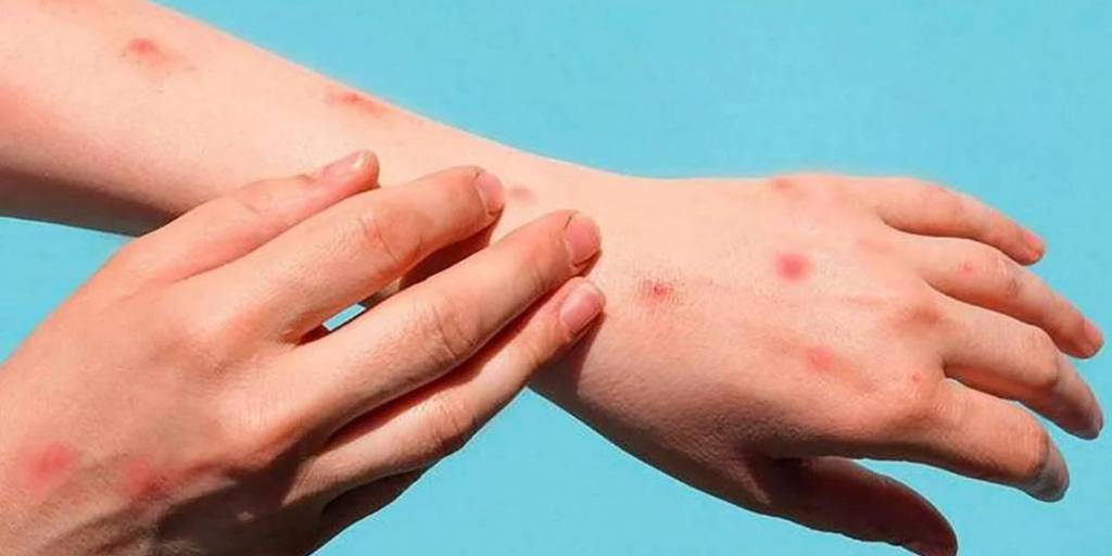 Viruela del mono: Uno de los síntomas principales son las erupciones en la piel