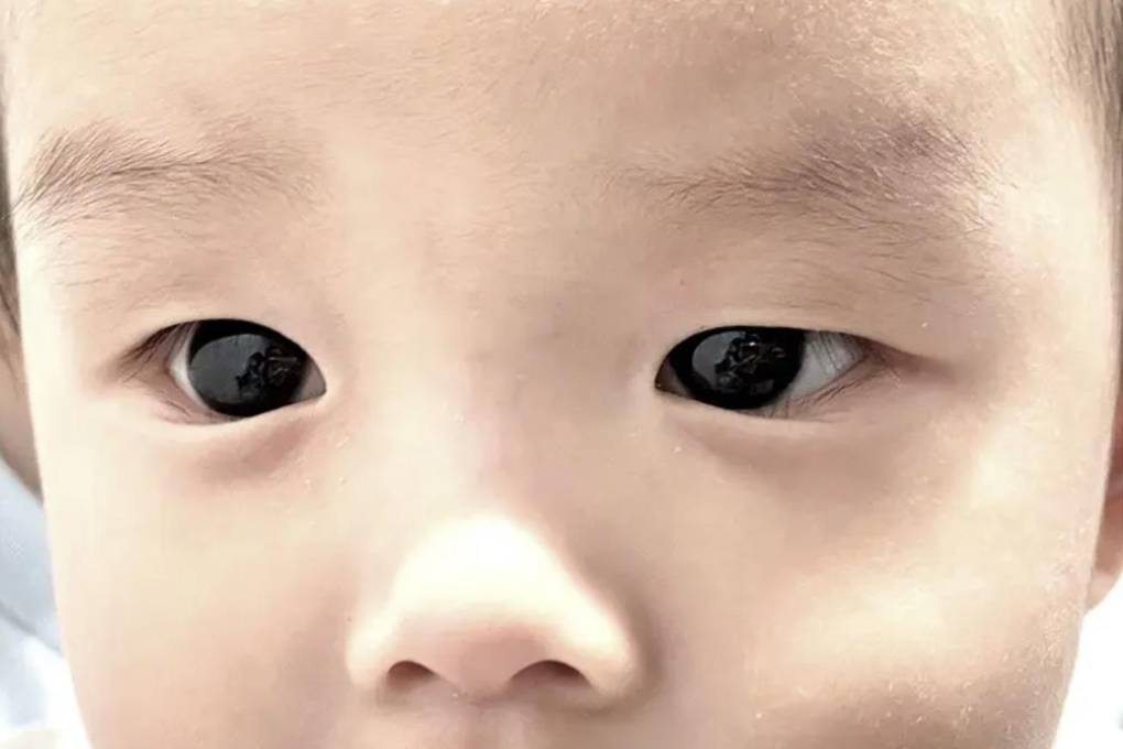 Los ojos del bebé después de suspender el tratamiento para el covid 19
