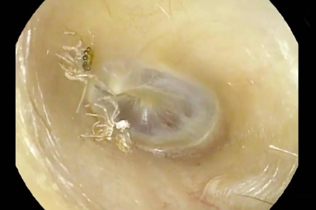 Una mujer tenía una araña atrapada en su oído 