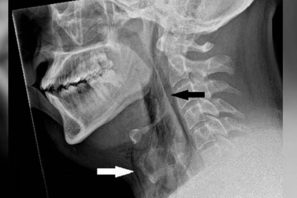 Radiografía del hombre afectado