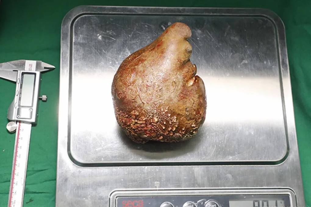 El cálculo renal más grande del mundo pesó 801 gramos