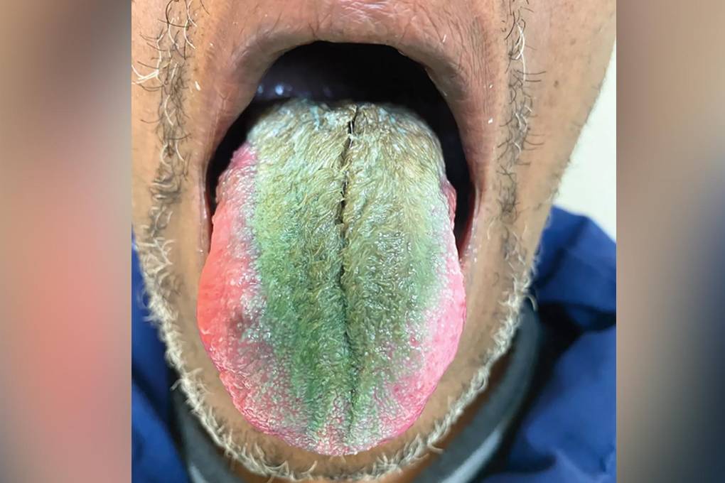 Así quedó la lengua del paciente que fumaba