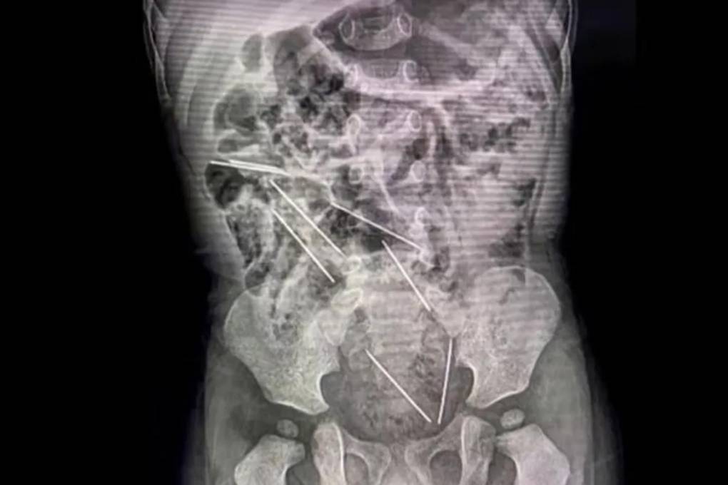 Radiografía del estómago de un niño que se tragó ocho agujas